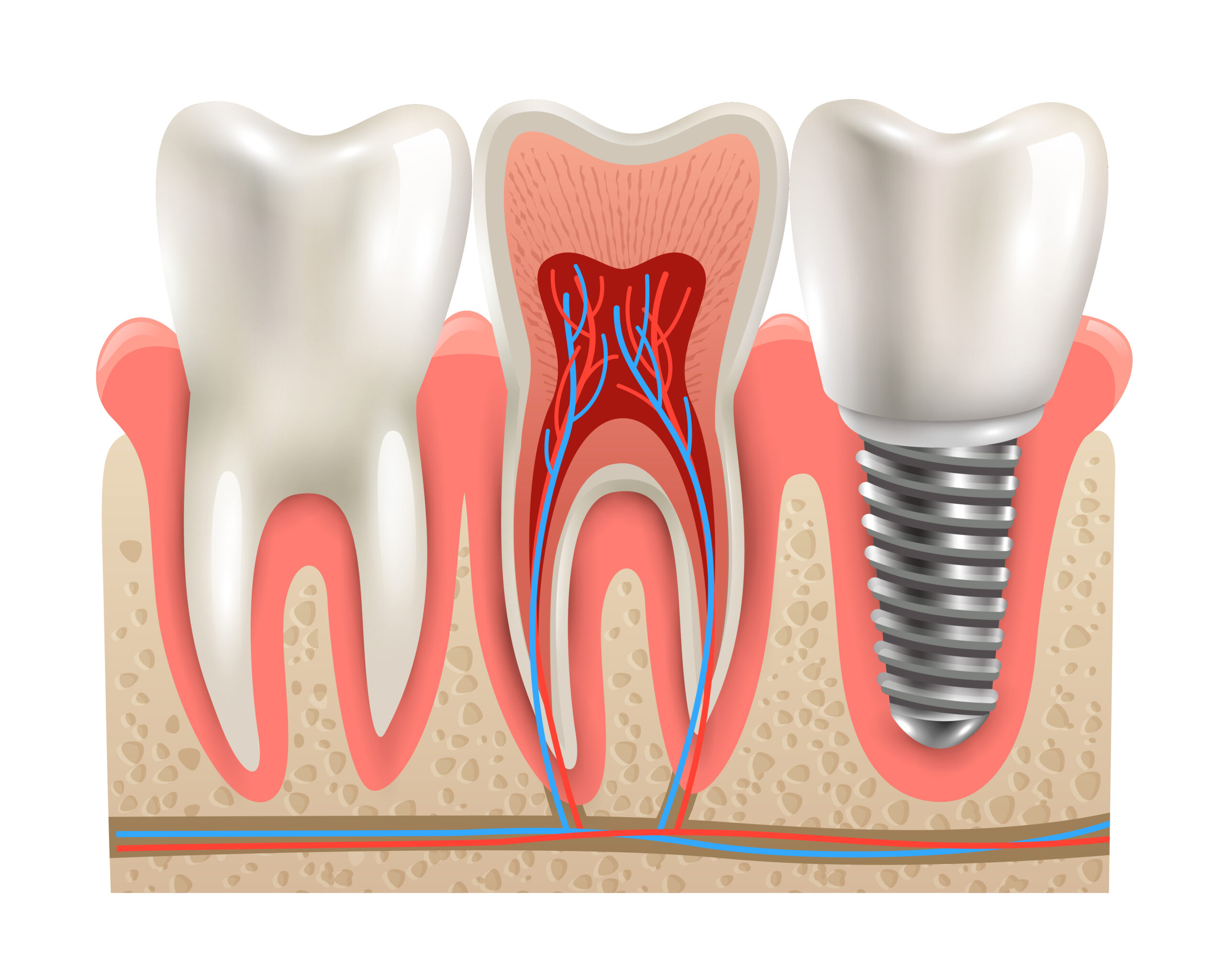 Tipurile de implanturi dentare - care este cel potrivit pentru tine?